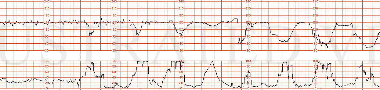 DrGarite-02230section2.gif  Variable Decelerations - Category II  Illustrated Verdict, Inc.