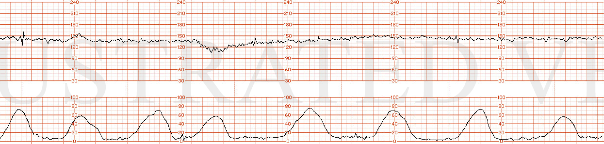 Q153-DrDepp-SCT-MD-Q153-panel2gif  Prolonged Decel : Category II  Illustrated Verdict, Inc.