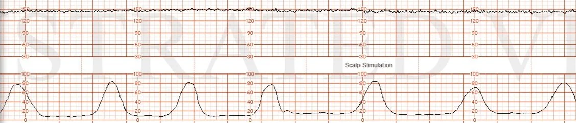 Dr. Burgansky 0255 Cat II  Minimal variability  Illustrated Verdict, Inc.