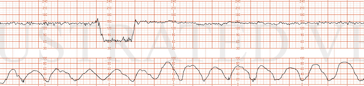 Dr. Clark q007  Excessive Uterine Activity  Illustrated Verdict, Inc.